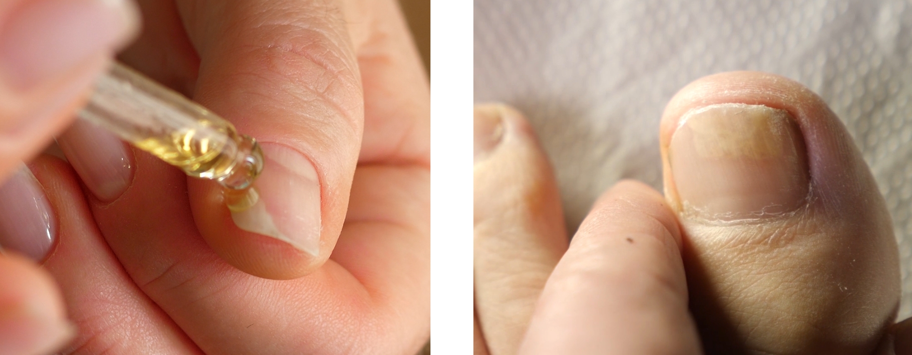 onycholiza jak wygląda